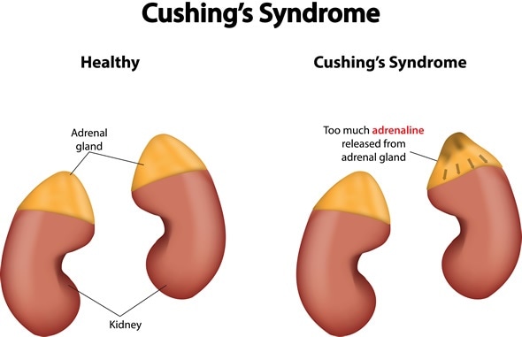 Cushing's Syndrome - Image Copyright: joshya / Shutterstock